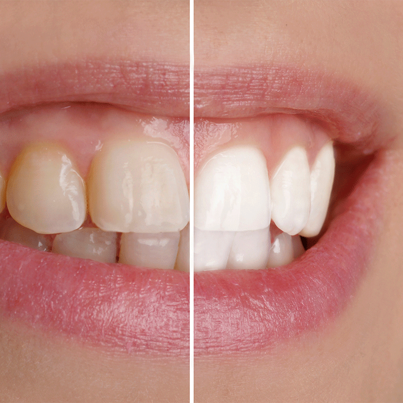 Careum Dentalhygiene Bleaching weisse Zähne